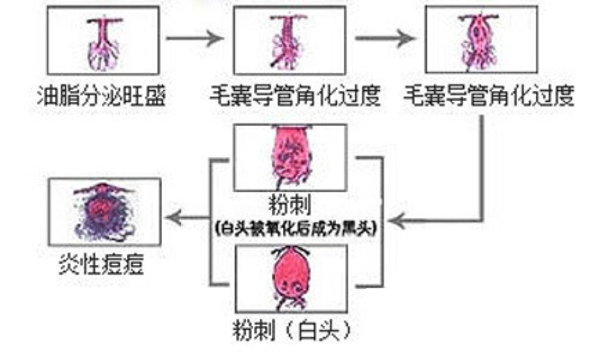 找对原因和痘说bye bye